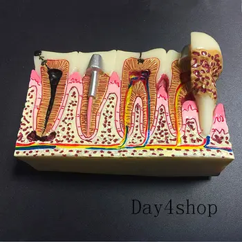 Carii dentare Dinte Model frecvente patologii model model de predare ,Dinte la Dentist pentru Predarea științelor